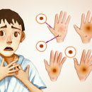 Giới thiệu về Pimecrolimus